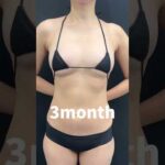 バストアップ神症例3選‼️#shorts  #豊胸 #美容整形