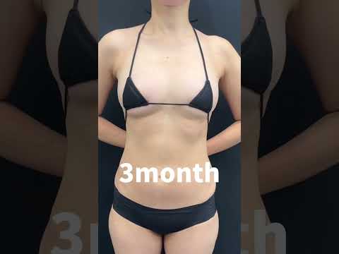 バストアップ神症例3選‼️#shorts  #豊胸 #美容整形