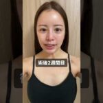 豊胸Vlog🌟#脂肪注入豊胸 #産後ママ #バスト #インスタグラマー #ブイログ #shorts