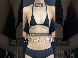 【神定着】人生変わる豊胸術‼️#バストアップ #shorts