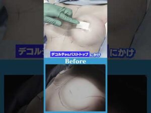 【シリコンバッグ豊胸】バストアップで！胸元を開いた服を着たい！#shorts  #美容整形 #豊胸 #整形 #美容#東京美容外科