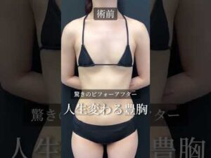 【人生変わる】水着も映える豊胸術‼️#バストアップ #美容整形 #shorts