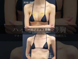 バストアップしてスタイル抜群🌟#スタイルアップ #バストアップ #盛れる #気分が上がる #豊胸手術 #女医 #shorts