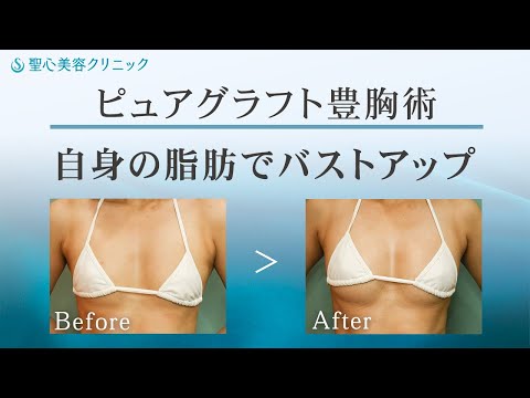 【ピュアグラフト豊胸術】高純度の脂肪注入で自然なバストアップ【聖心美容クリニック】#ピュアグラフト豊胸術 #ピュアグラフト #豊胸 #濃縮脂肪注入 #プレミアムピュアグラフト #ベイザーリポ