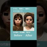 20代後半、糸リフトケア1回