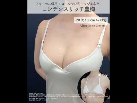 脂肪豊胸症例🎀 #脂肪豊胸 #谷間 #バストアップ #アキーセル #リジェネラ #症例