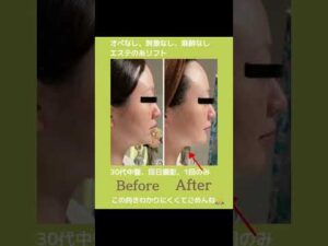 30代中盤、糸リフトケア1回