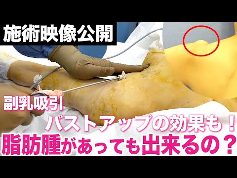 副乳×脂肪腫…本当に吸引できる？バストアップ効果もあるって本当？驚きの結果に！【脂肪吸引】