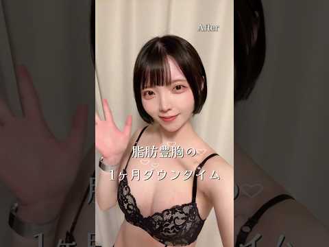 【脂肪豊胸】1か月のダウンタイム#湘南美容クリニック #美容 #美容整形