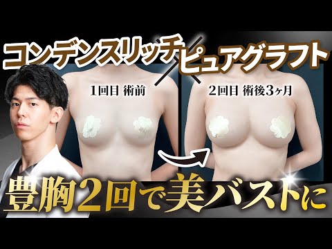 【脂肪豊胸2回】コンデンスリッチ×ピュアグラフトで大満足すぎるバストに！