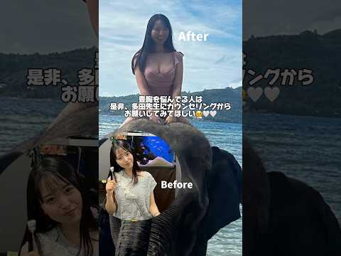 ふわふわバストをGETする豊胸vlog🤍 #豊胸手術 #脂肪注入 #vlog #ダウンタイム #バストアップ