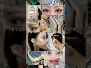 【整形総額1300万円越え💸】一番やって良かった手術は…#美容整形 #美容 #湘南美容クリニック