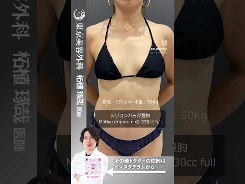 授乳歴3回！下垂したおっぱいを整ったバストラインに！ #shorts #ドクターa #美容 #東京美容外科 #整形 #麻生泰 #美容整形 #池袋 #赤坂 #バストアップ #コンプレックス