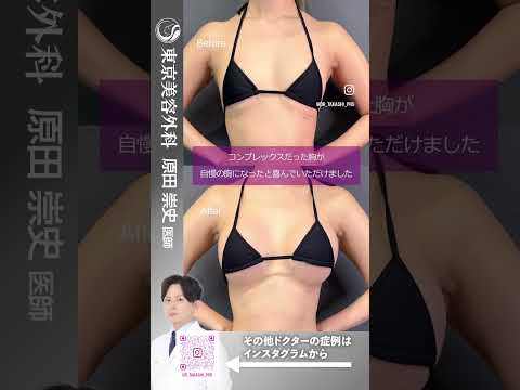 スマートな方でもしっかりとしたバストアップ！ #shorts #ドクターa #美容 #東京美容外科 #整形 #麻生泰 #美容整形 #池袋 #豊胸 #バストアップ #コンプレックス
