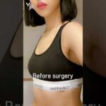 豊胸でバストアップ💖 Before & After #韓国整形 #ビフォアーアフター #豊胸 #豊胸手術 #豊胸術 #バストアップ #ボリュームアップ #美容外科症例 #韓国美容外科