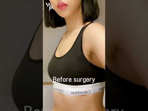 豊胸でバストアップ💖 Before & After #韓国整形 #ビフォアーアフター #豊胸 #豊胸手術 #豊胸術 #バストアップ #ボリュームアップ #美容外科症例 #韓国美容外科