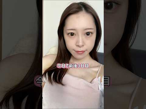 ダウンタイム３日目💖#湘南美容クリニック名古屋院 #バストアップ #美容カウンセラー #美容コンシェルジュ #豊胸