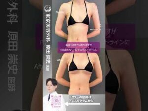 シリコンバッグでも自然なおっぱいの仕上がりにサイズアップ！！ #shorts #ドクターa #美容 #東京美容外科 #整形 #麻生泰 #美容整形 #池袋 #豊胸 #バストアップ #コンプレックス