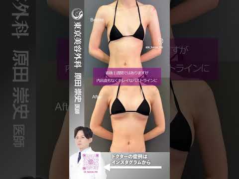 シリコンバッグでも自然なおっぱいの仕上がりにサイズアップ！！ #shorts #ドクターa #美容 #東京美容外科 #整形 #麻生泰 #美容整形 #池袋 #豊胸 #バストアップ #コンプレックス