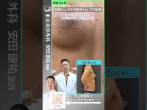 シリコンバッグでバストアップと左右差改善！ #shorts  #ドクターa #美容 #東京美容外科 #整形 #麻生泰 #美容整形 #新宿 #豊胸 #バストアップ #コンプレックス