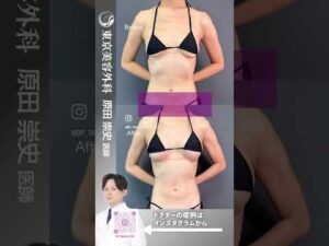 授乳で垂れたおっぱい…勇気を出してハリのある胸に！！#shorts #ドクターa #美容 #東京美容外科 #整形 #麻生泰 #美容整形 #池袋 #豊胸 #バストアップ #コンプレックス