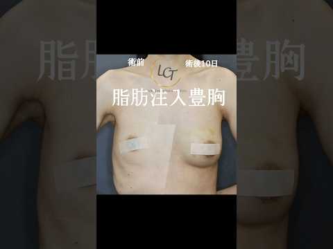華奢な体型、授乳後ママの味方‼︎#ショート動画 #shorts #脂肪注入豊胸 #豊胸 #バストアップ #形成外科専門医 #キャンペーン #ルミエール #モニター募集 #胸#メリハリBODY