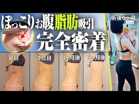 ダウンタイムも分かる脂肪吸引密着！筋トレしても落ちないお腹の脂肪バストに移して超メリハリボディに【松元宗一郎】