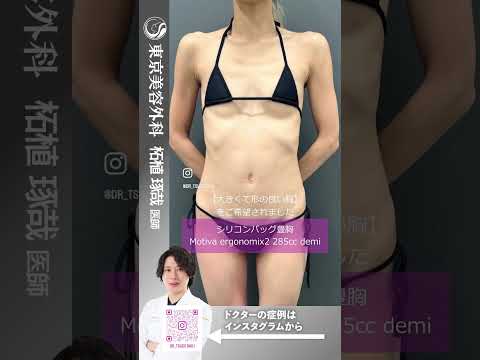 痩せ型の方でも自然なボリュームアップ【シリコンバッグ豊胸】#shorts  #美容 #東京美容外科 #整形 #美容整形 #赤坂 #豊胸 #バストアップ #コンプレックス#美乳 #ビフォーアフター