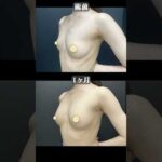 脂肪豊胸でハリのあるバストに！ #shorts  #脂肪吸引 #脂肪豊胸