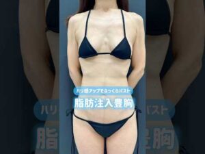 授乳後に大人気の脂肪豊胸👙バストアップ目的ではなく、垂れた胸を改善したい、ハリを取り戻したいそんな方にもおすすめです✨ #脂肪豊胸 #豊胸 #ルラ美容クリニック#ルラ美容クリニック名古屋本院