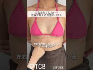 【ヒアルロン酸豊胸】左右差なくしたい…豊胸で叶える理想のバスト