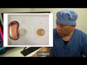 シリコン豊胸はバレる？浮き出て不自然なバストになる原因と自然に戻す症例解説を動画で解説！